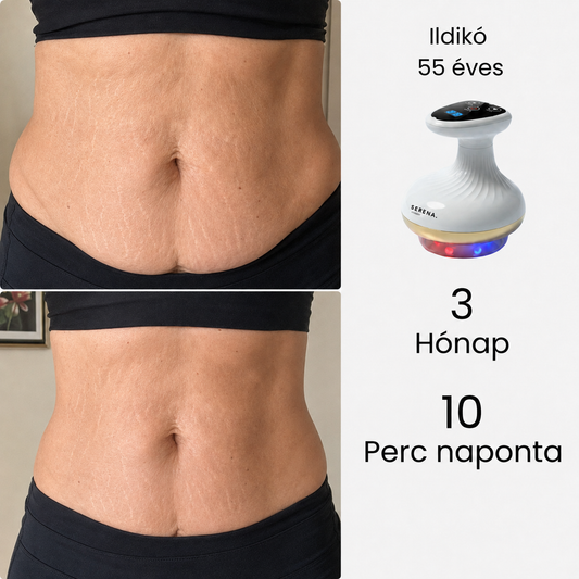 SERENA™ Narancsbőrkezelő 2.0 – a feszesebb és tónusosabb bőrért